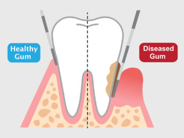 Can Teeth Be Whitened with Cavities or Gum Disease?