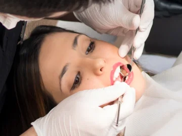How Long Does Numbness Last After a Root Canal?